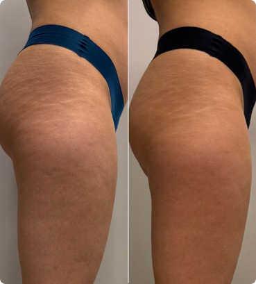 endermologia