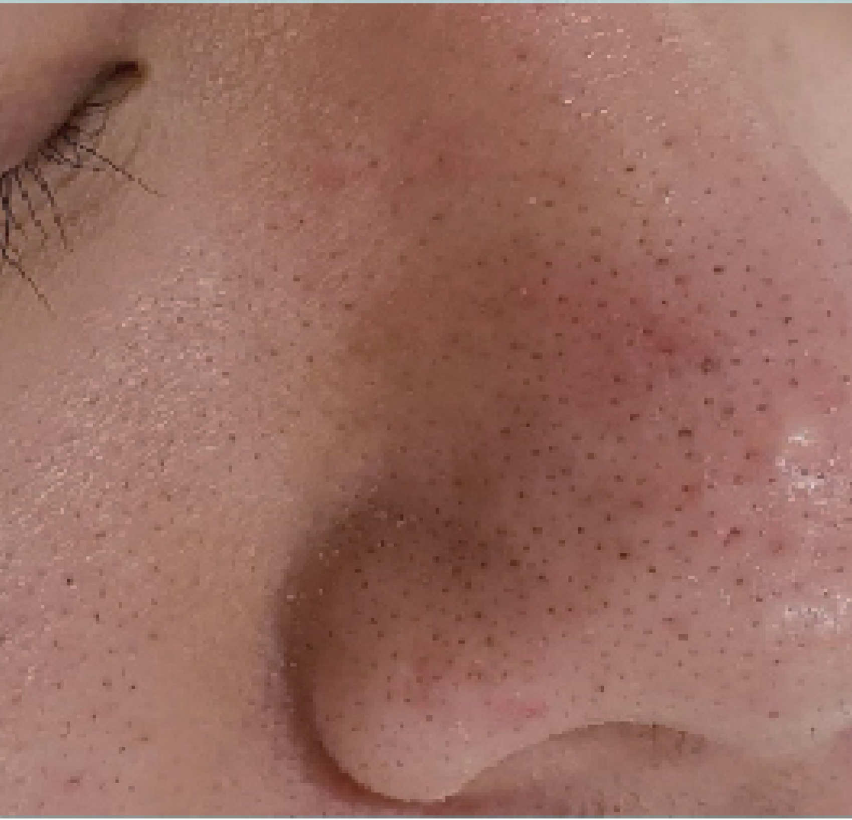 Inpure Multi-Active Therapy — Przed