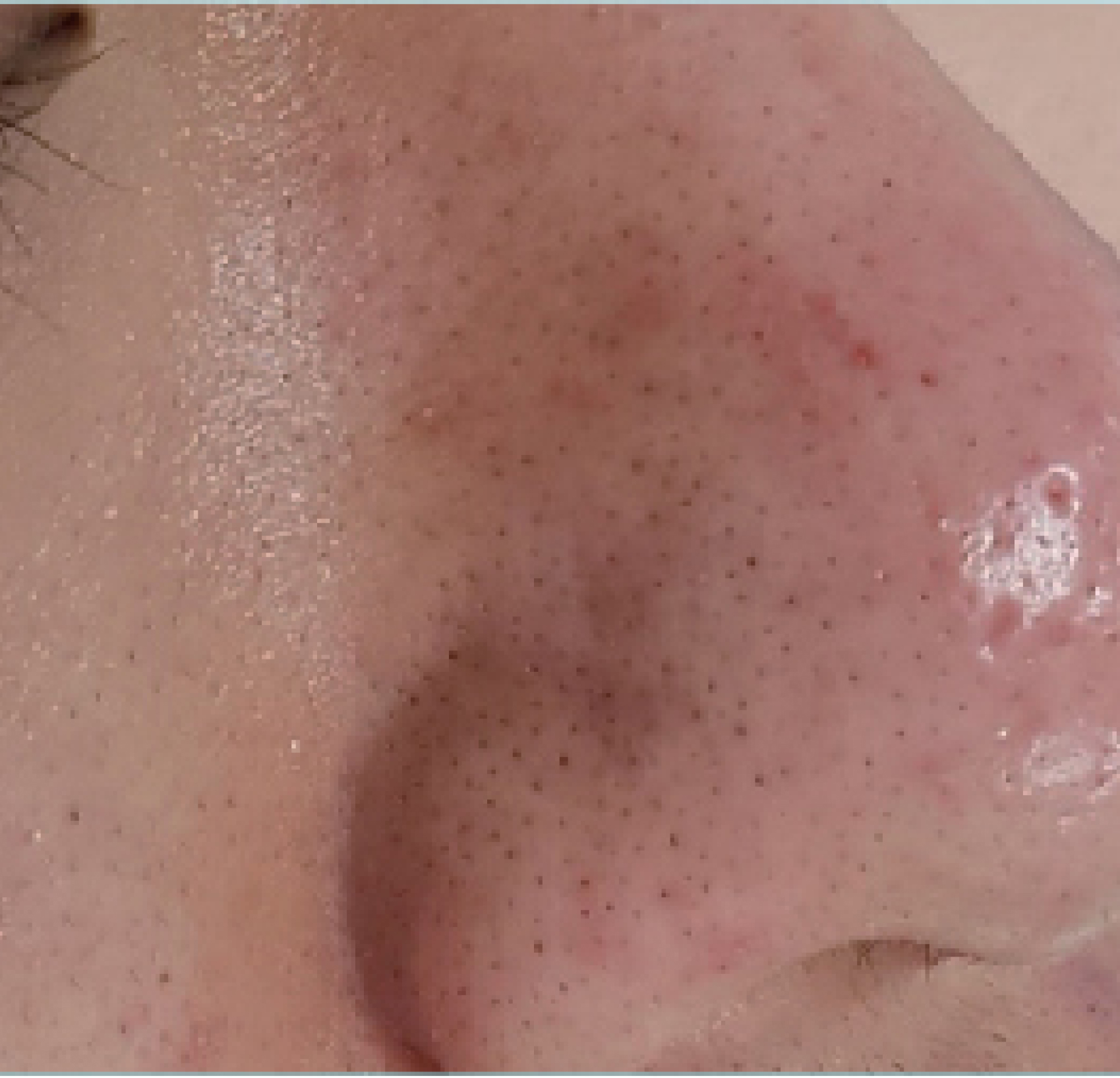 Inpure Multi-Active Therapy — Po