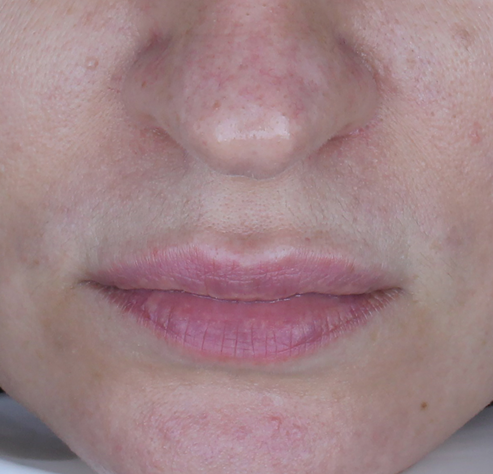 Cosmo S-Peel™ Nano Boost — Po