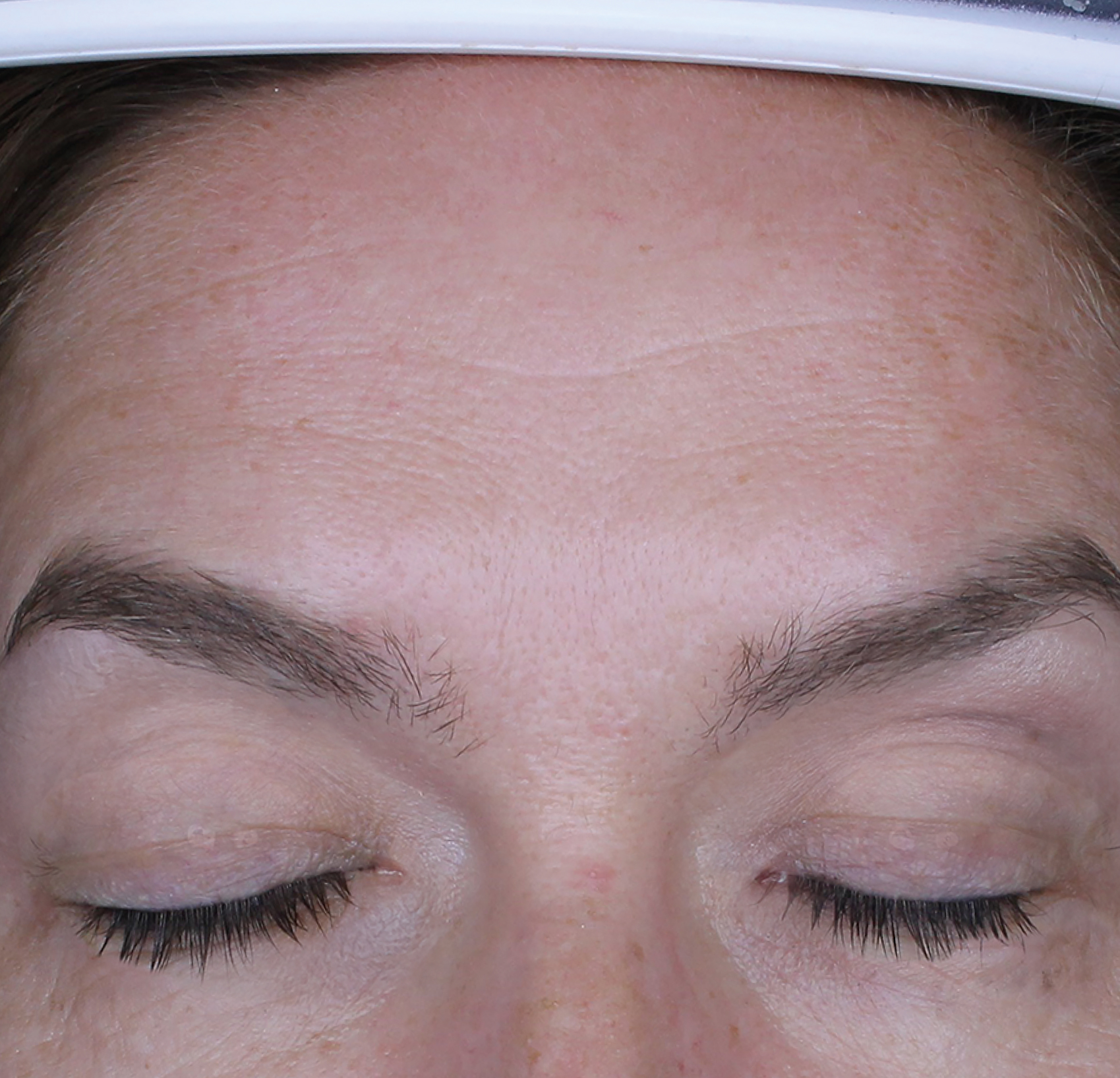 Cosmo S-Peel™ Nano Boost — Przed