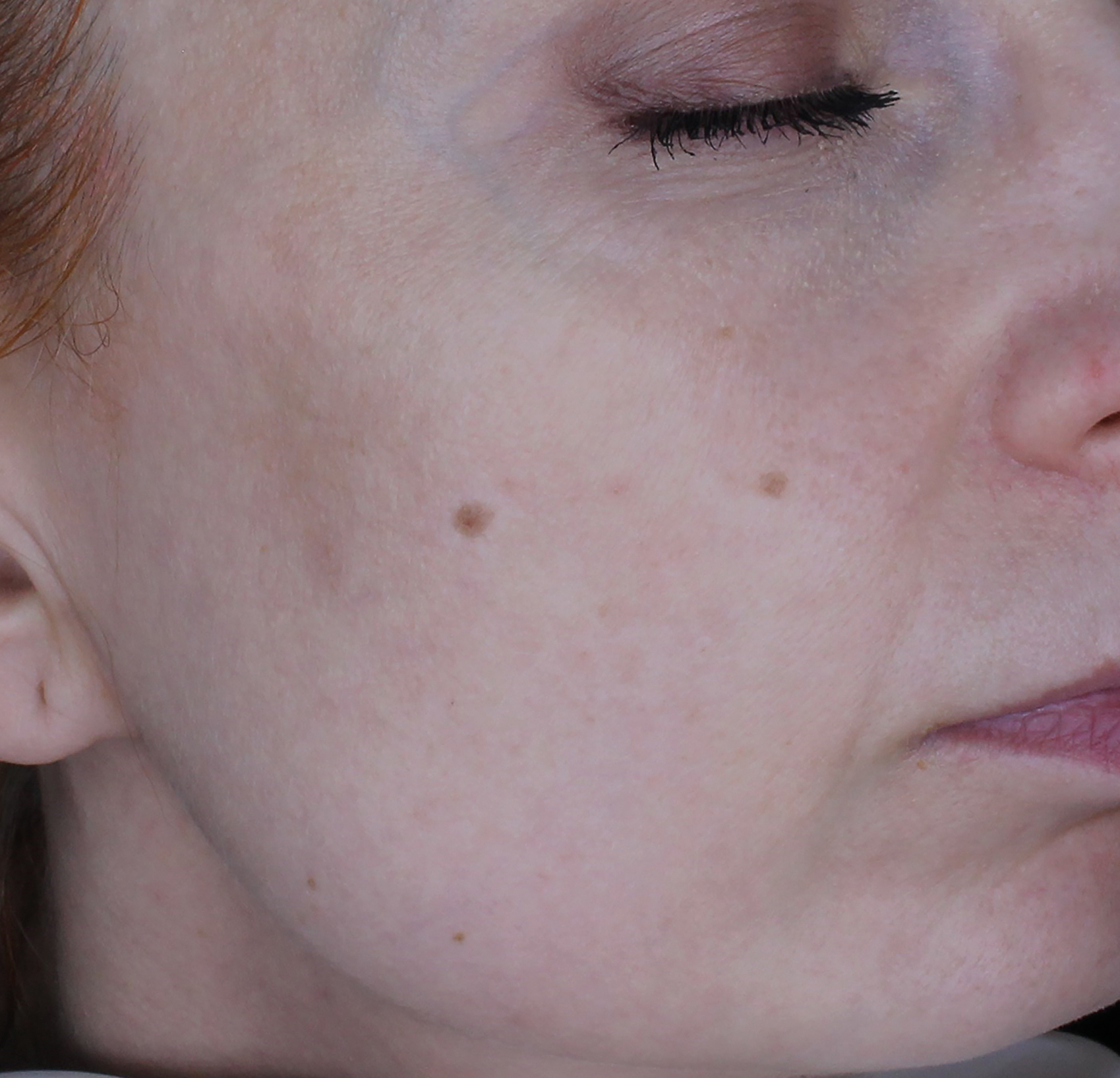 Cosmo S-Peel™ Nano Boost — Po