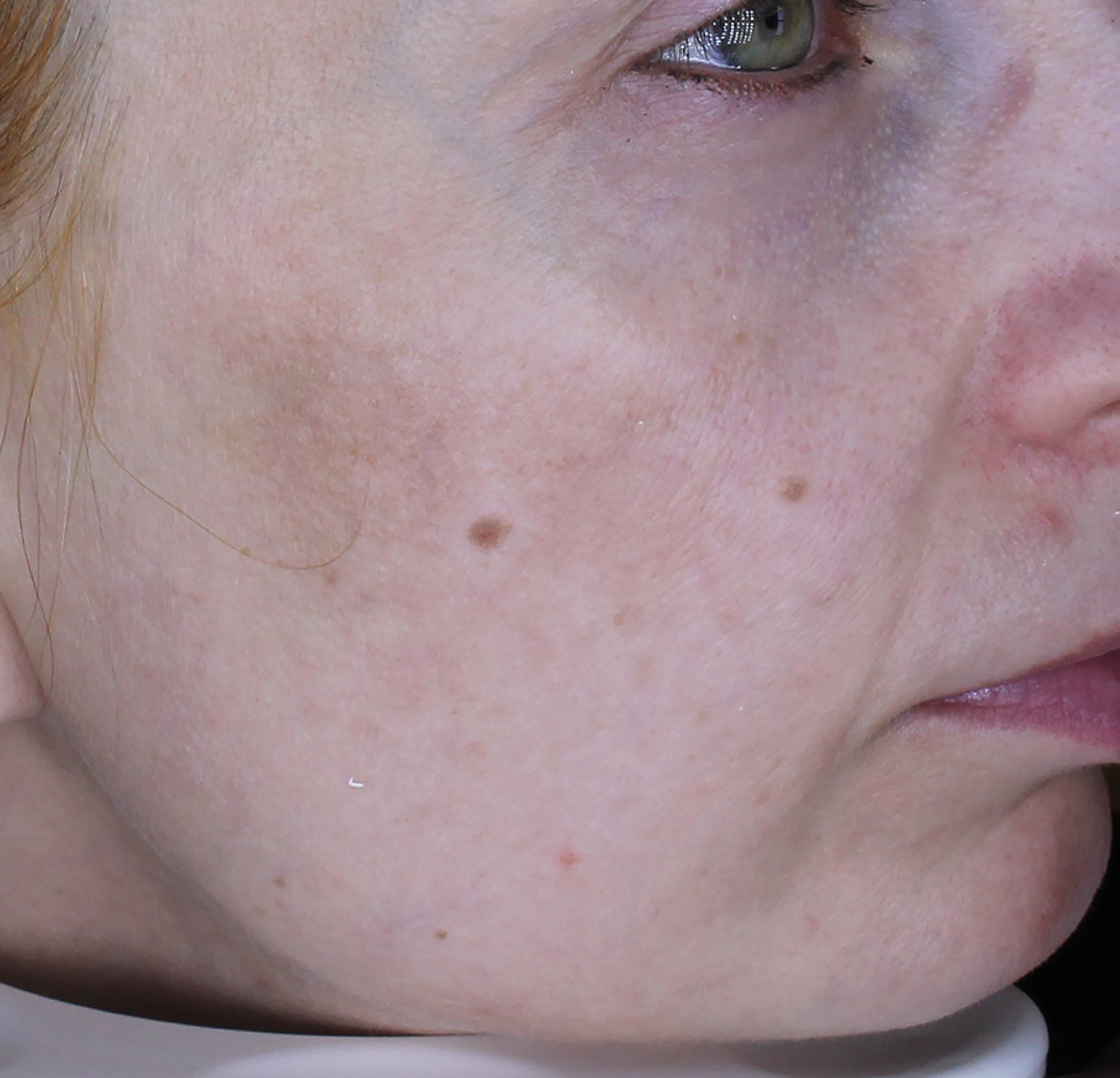 Cosmo S-Peel™ Nano Boost — Przed