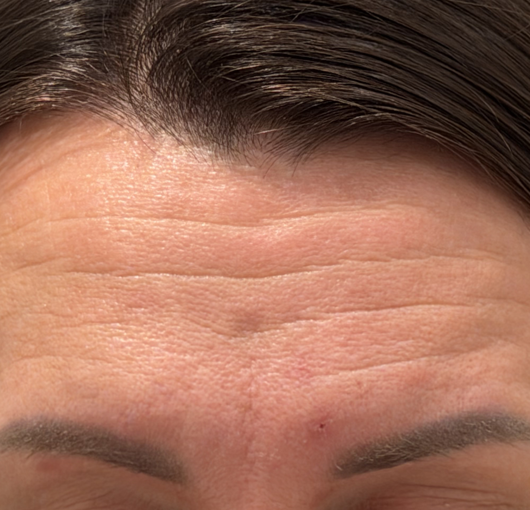 Toksyna botulinowa — Przed