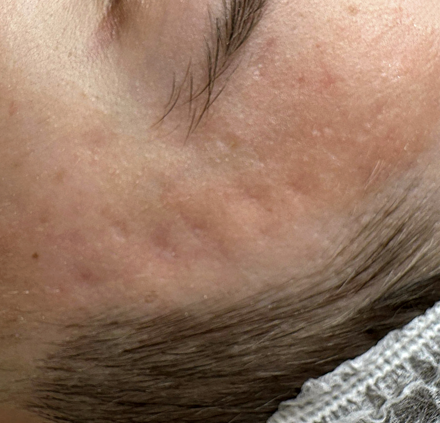 Terapia łączona Laser Me & Dermapen — Po