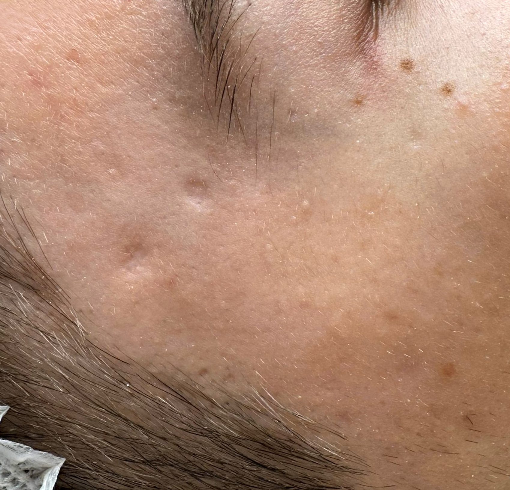Terapia łączona Laser Me & Dermapen — Po