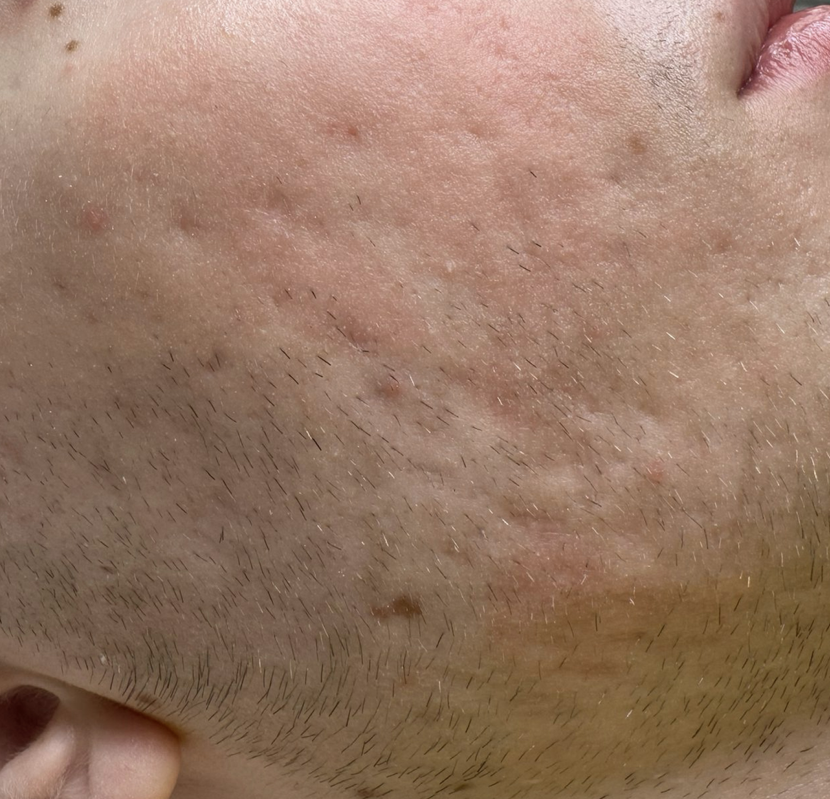 Terapia łączona Laser Me & Dermapen — Po