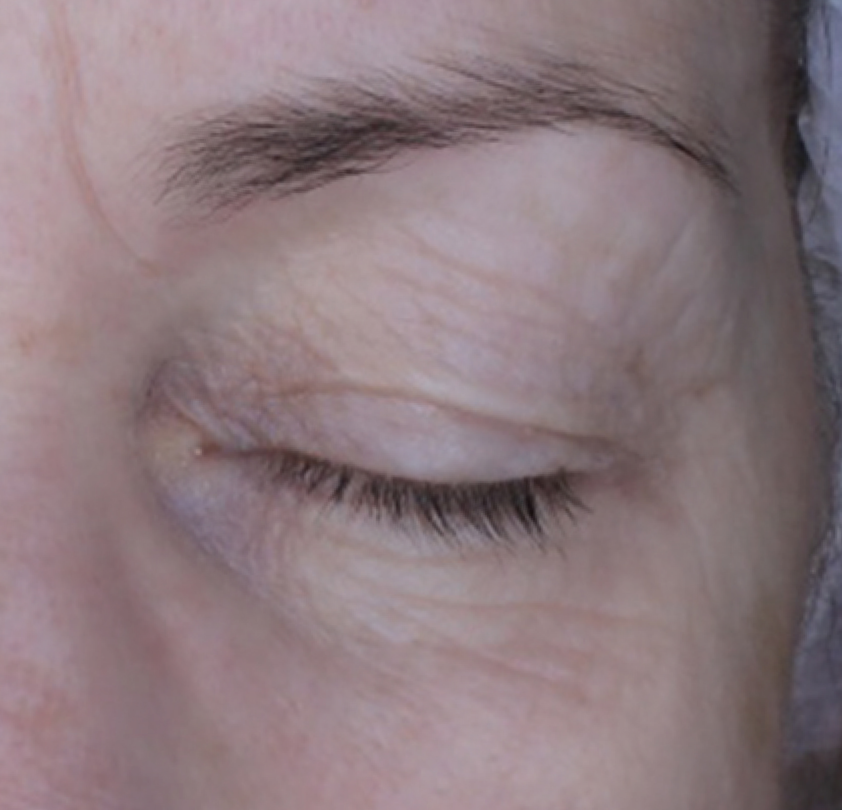 Tri-ExoGF™ Eye Focus Therapy — Po