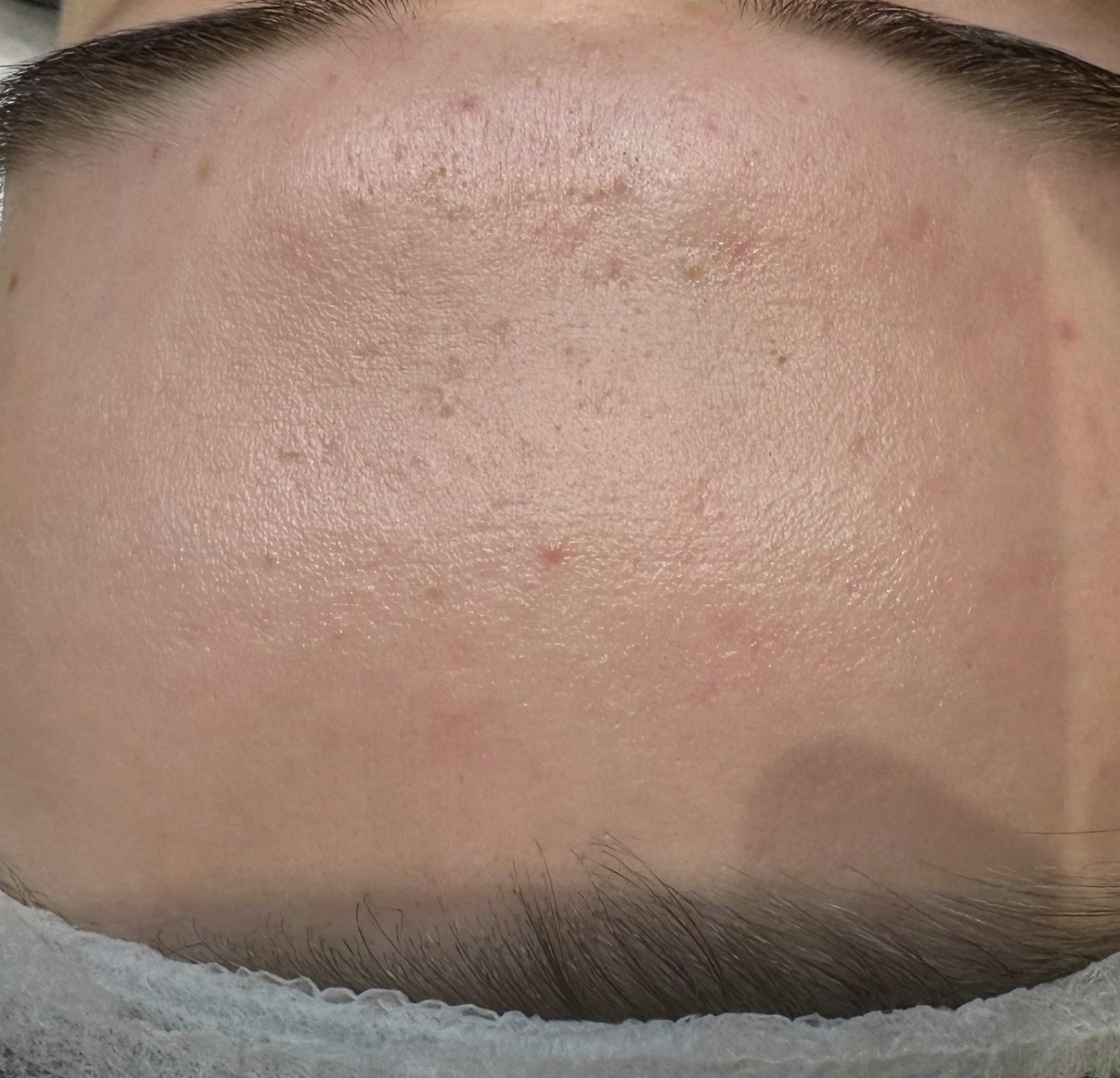 Terapia łączona Laser Me & Dermapen — Po