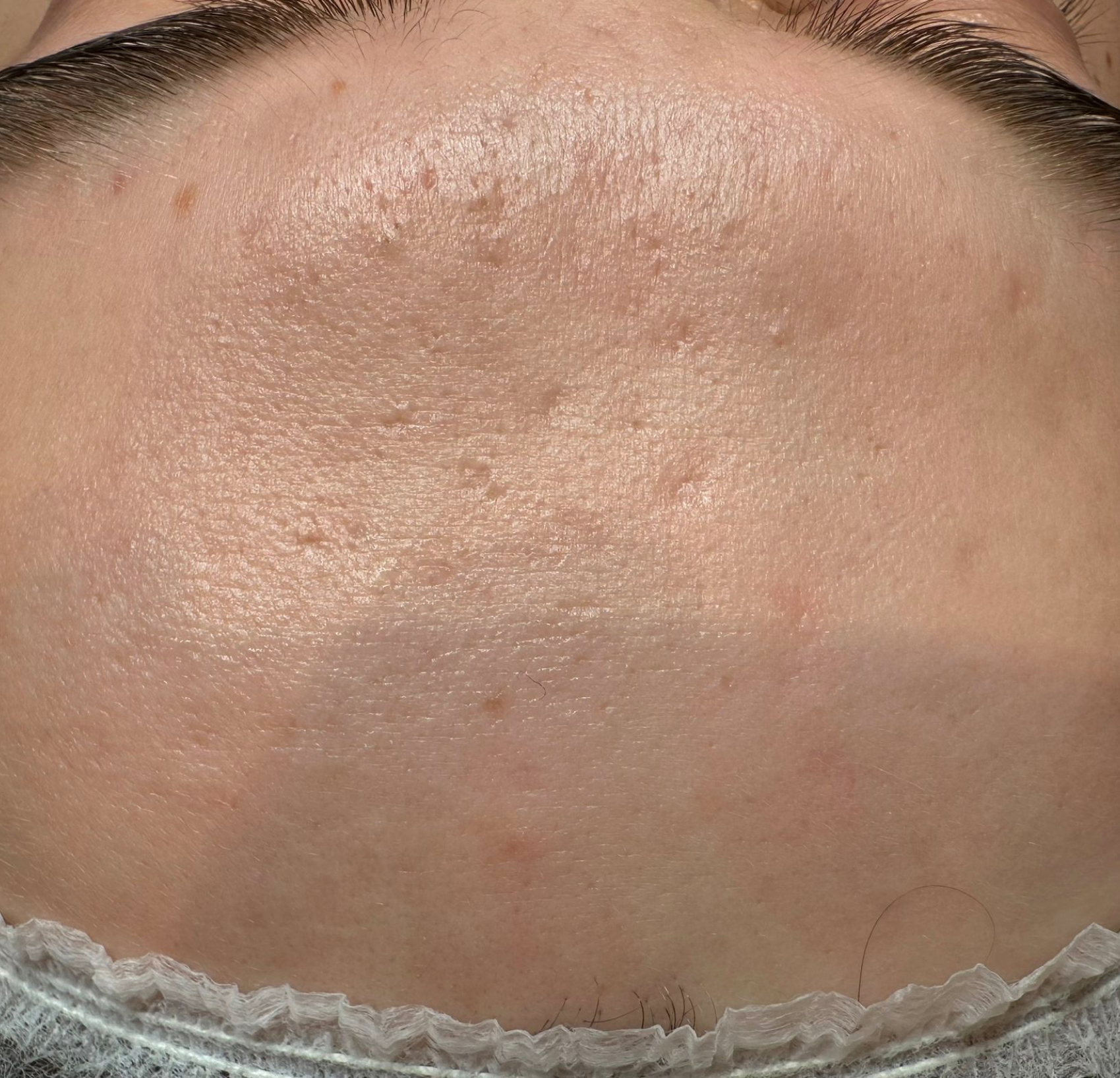 Terapia łączona Laser Me & Dermapen — Przed