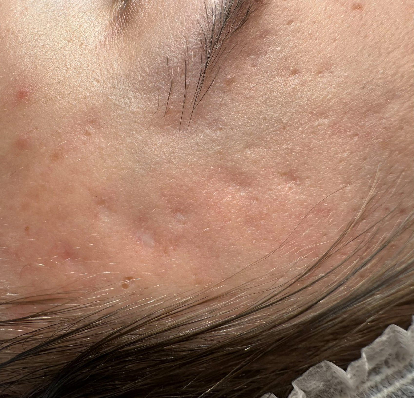 Terapia łączona Laser Me & Dermapen — Przed