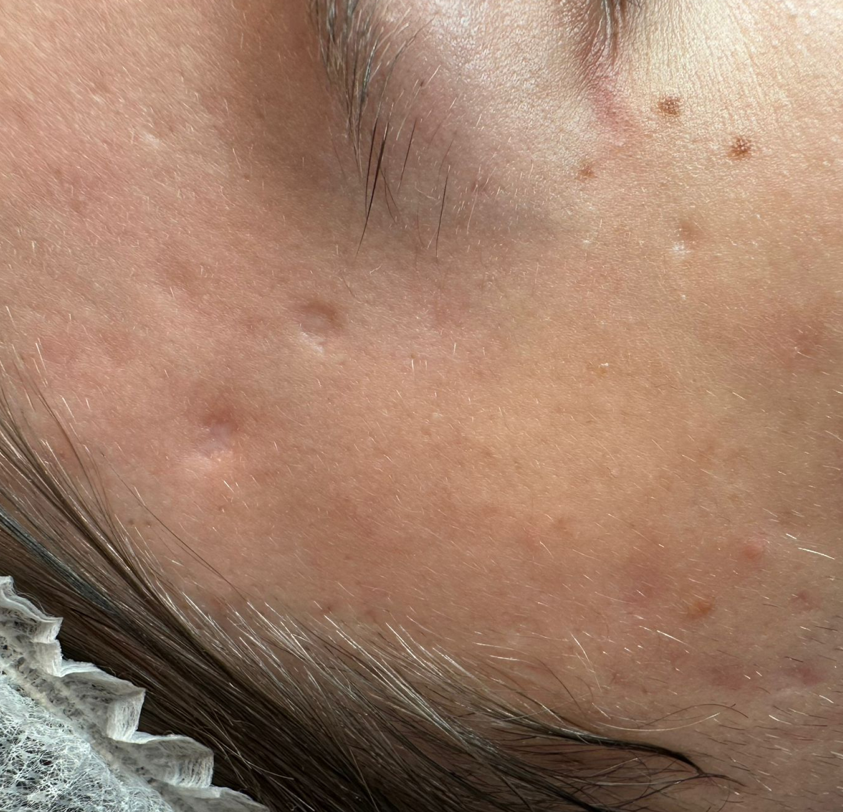 Terapia łączona Laser Me & Dermapen — Przed