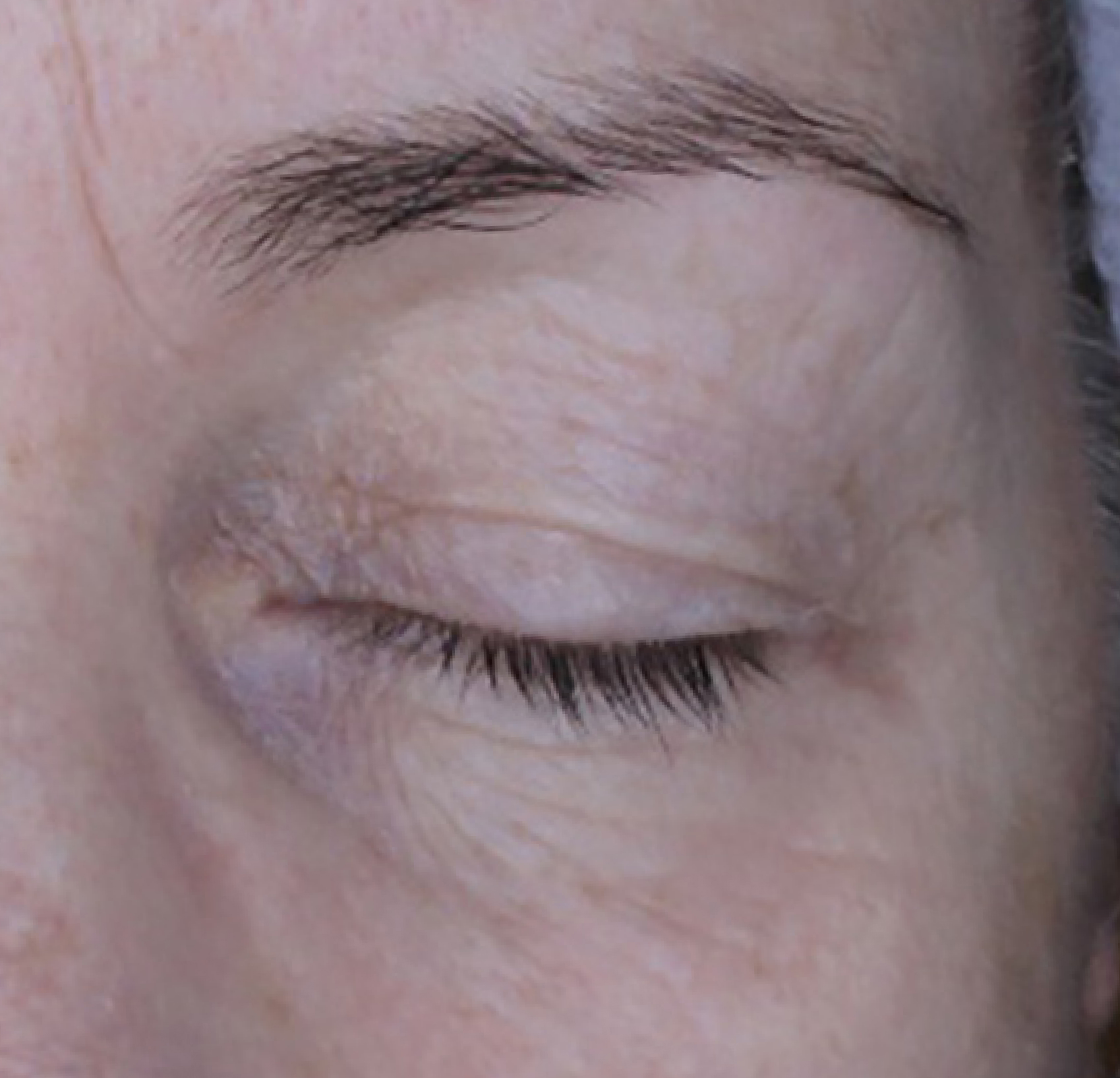Tri-ExoGF™ Eye Focus Therapy — Przed