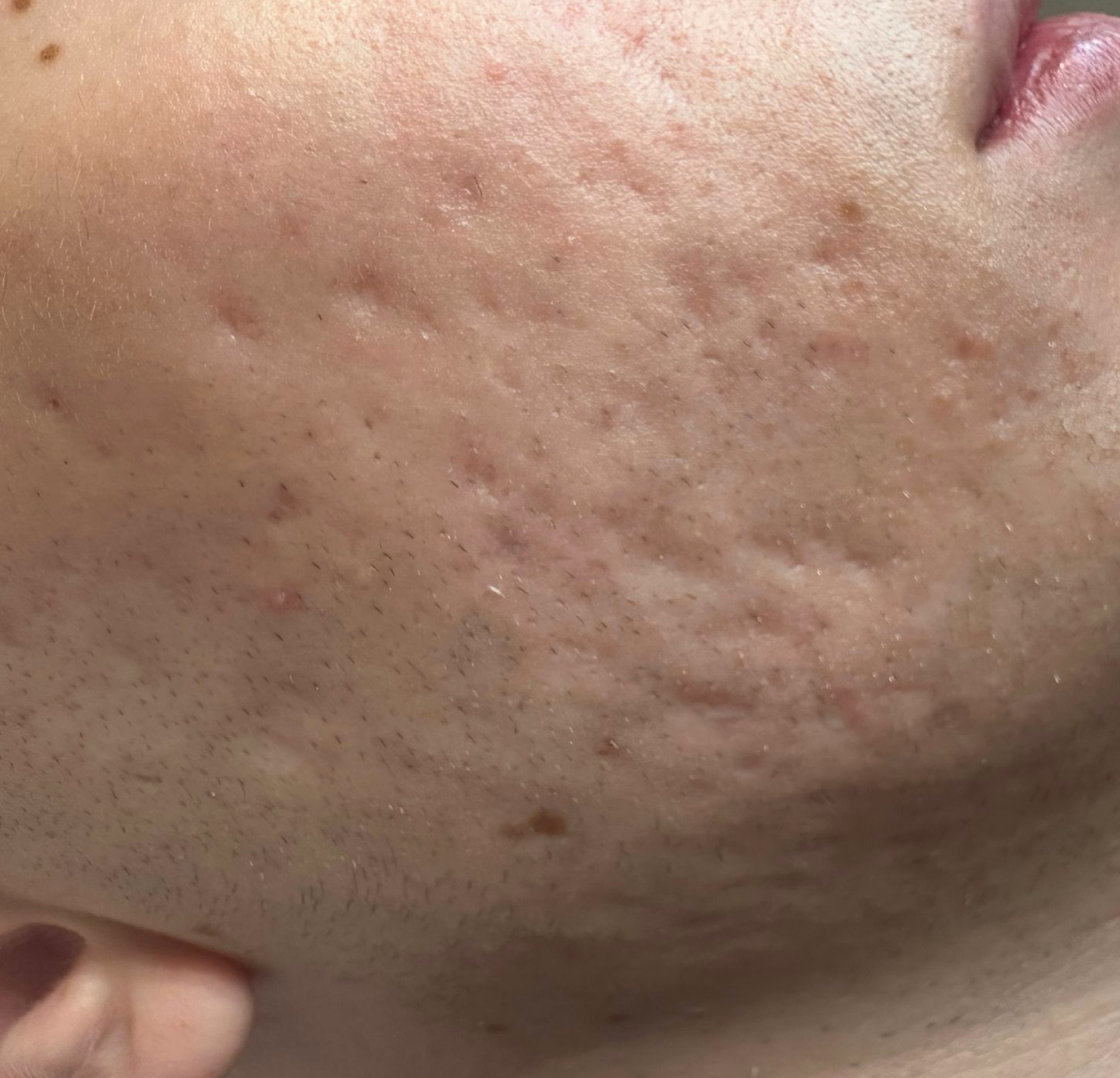 Terapia łączona Laser Me & Dermapen — Przed